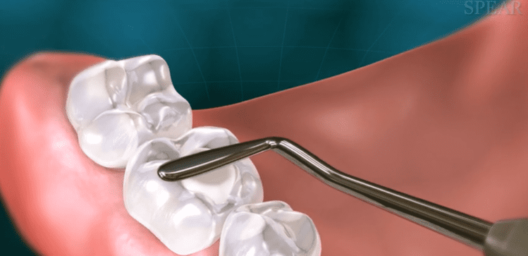 Composite Filling