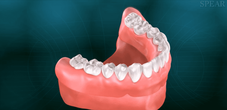 Dentures