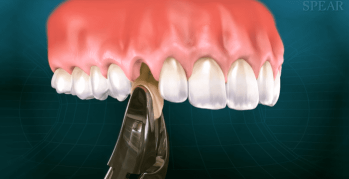 Extractions