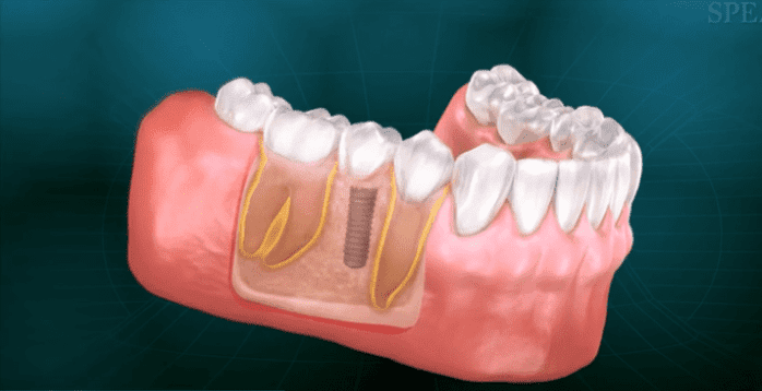 Implants