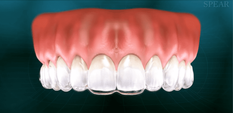 Teeth whitening